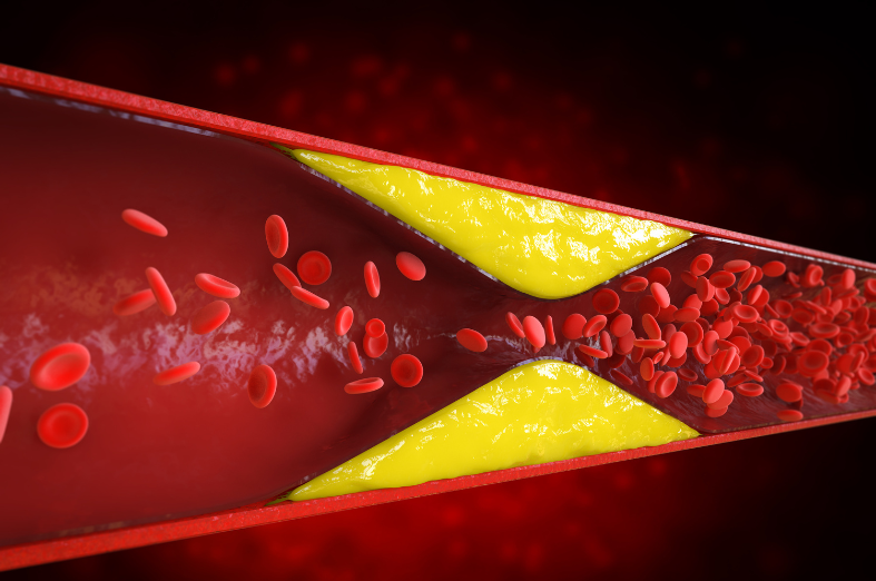 Gordura no Sangue Como Controlar e Evitar Riscos à Saúde