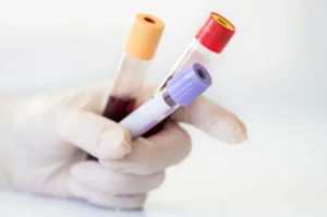 hipertrigliceridemia- dra ana barbara trizzoti endocrinologista botucatu